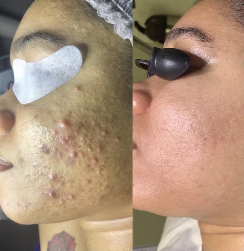 Before and after acne treatment for your face