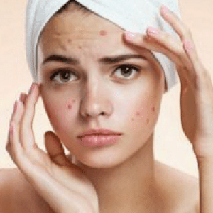 Acne Program Acne Program