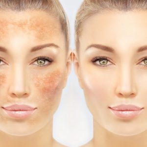 hyperpigmentation hyperpigmentation